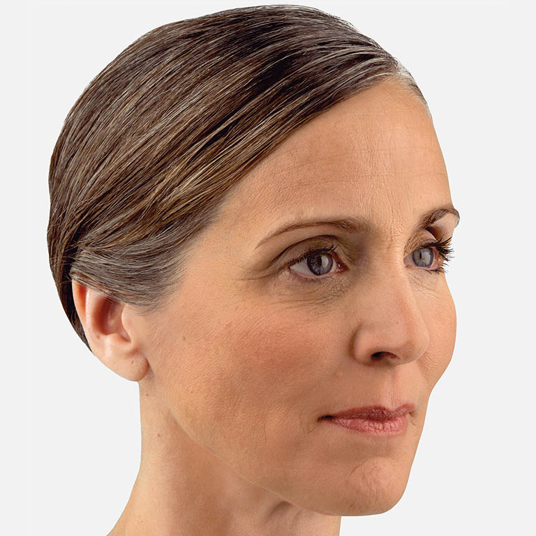 Juvedéderm Voluma XC - After
