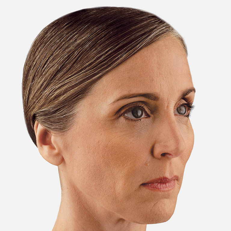 Juvedéderm Voluma XC - Before
